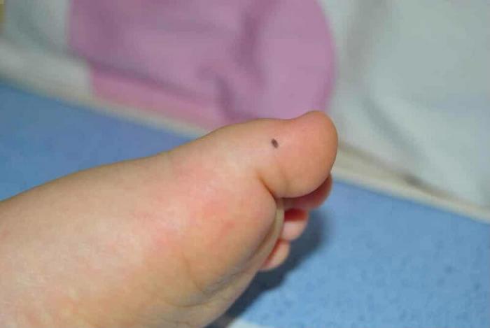 Giải thích ý nghĩa nốt ruồi trên chân phụ nữ