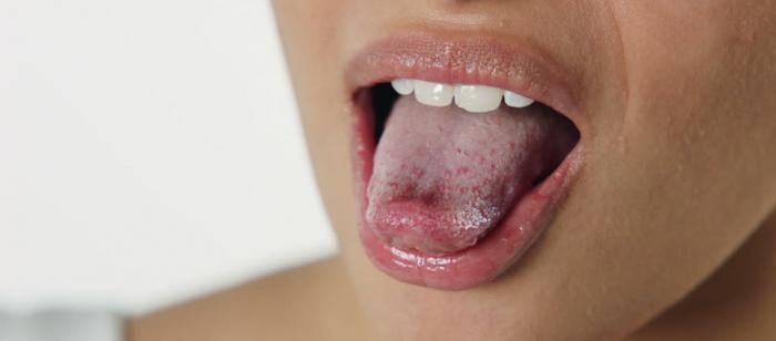 Tìm thấy nốt ruồi định mệnh trên lưỡi?