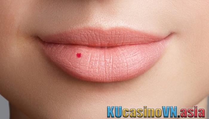 mọc nốt ruồi son