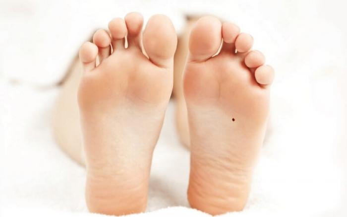 Nốt ruồi ở lòng bàn chân phải có ý nghĩa gì
