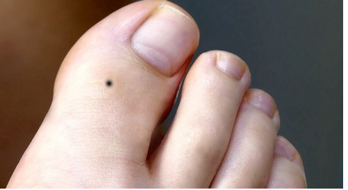 Nốt ruồi ở ngón chân cái nói lên điều gì?
